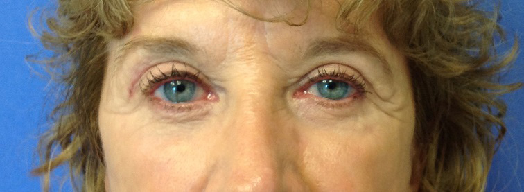 eyelid surgery fort myers